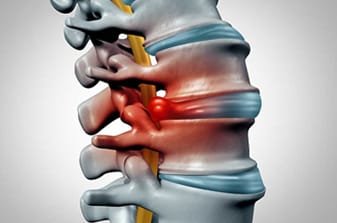 Book appointment for your spinal infection treatment by Dr Surya Prakash, Best Spine Surgeon in Hyderabad India