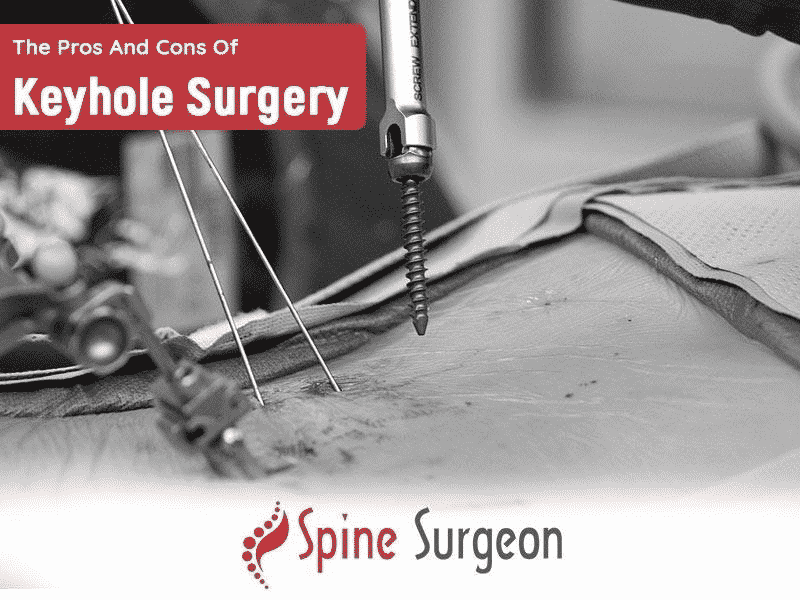 The Pros And Cons Of Keyhole Surgery