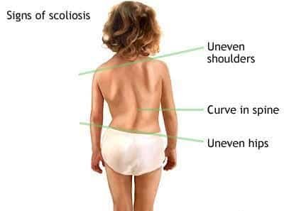 Treatment for Scoliosis in Hyderabad by Dr Surya Prakash Rao Voleti, Top Spine Surgeon in Hyderabad