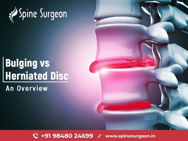Bulging vs Herniated Disc: An Overview