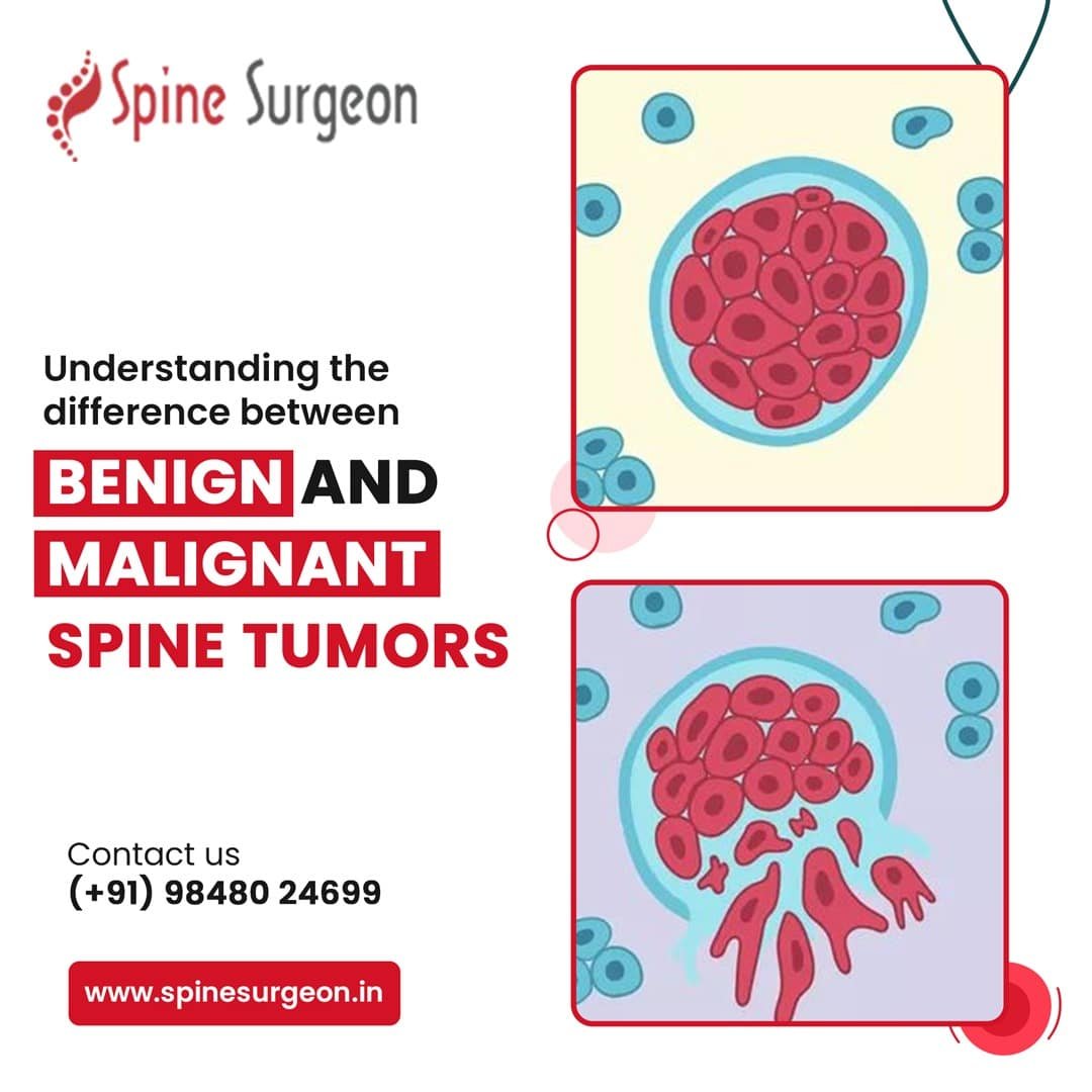 Understanding the difference between benign and malignant spine tumors ...